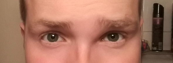Schwellung zwischen Auge und Nase auf der linken Seite von mir aus gesehen - (Augen, Entzündung, Schwellung)