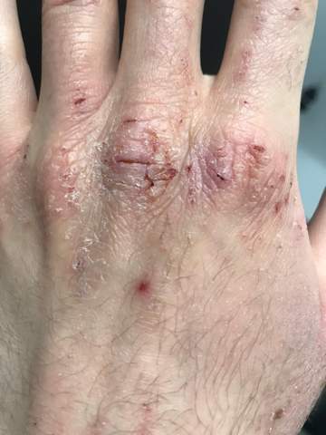 - (Haut, Gesundheit, Hand)