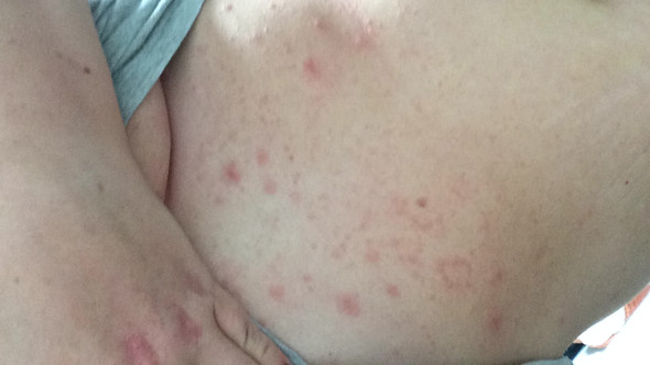 Am Bauch - (Haut, Ausschlag, Dermatologie)
