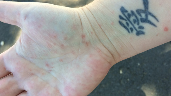 Handinnenfläche - (Haut, Ausschlag, Dermatologie)
