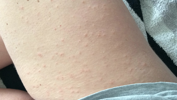 Oberschenkel - (Haut, Ausschlag, Dermatologie)