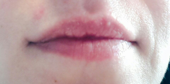 Seit Gestern Kleine Blaschen Auf Den Lippen Was Kann Das Sein Unreine Haut Seit Gestern Kleine Blaschen Auf Den Lippen Was Kann Das Sein Unreine Haut