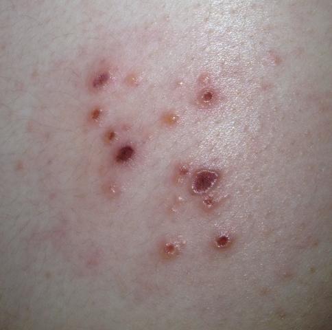 Seltsamer Ausschlag Und Kleine Wunden Auf Dem Rucken Ist Das Eine Gurtelrose Blaschen Seltsamer Ausschlag Und Kleine Wunden Auf Dem Rucken Ist Das Eine Gurtelrose Blaschen