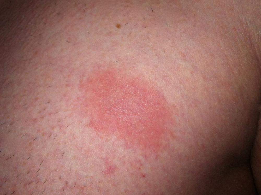 Seltsamer Roter Fleck Auf Der Brust Und Kleine Rote Flecken An Den Armen Haut Ausschlag Hiv Seltsamer Roter Fleck Auf Der Brust Und Kleine Rote Flecken An Den Armen Haut Ausschlag Hiv