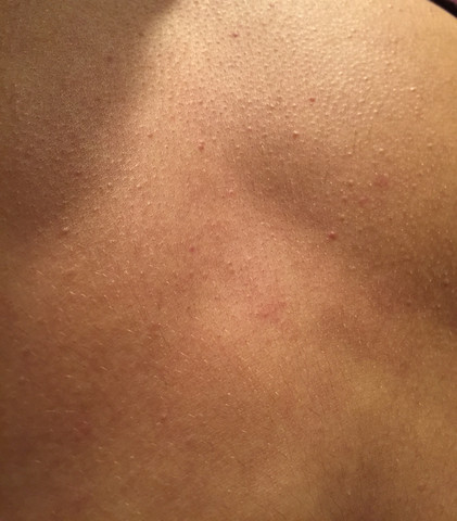 Brust(am Rücken sieht ähnlich aus) - (Pickel, Ausschlag, Akne)