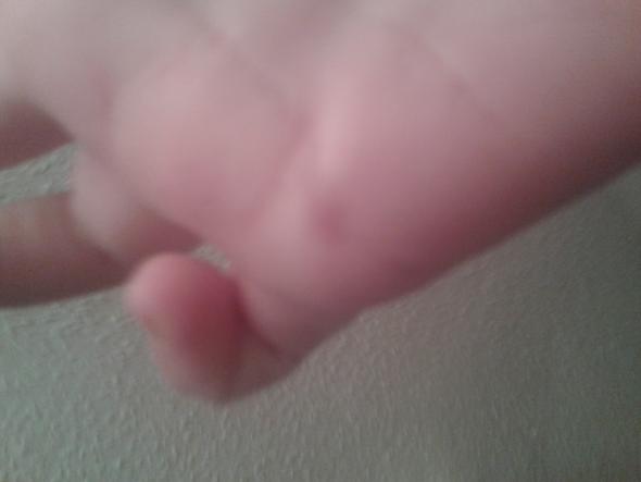 hand - (Schmerzen, Haut, Hand)