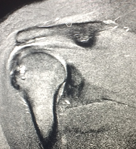 MRT-Bild der Schulter - (Orthopädie, MRT, Radiologie)