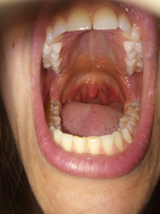 Sieht der Hals normal aus? (Schmerzen, HNO, Halsschmerzen)