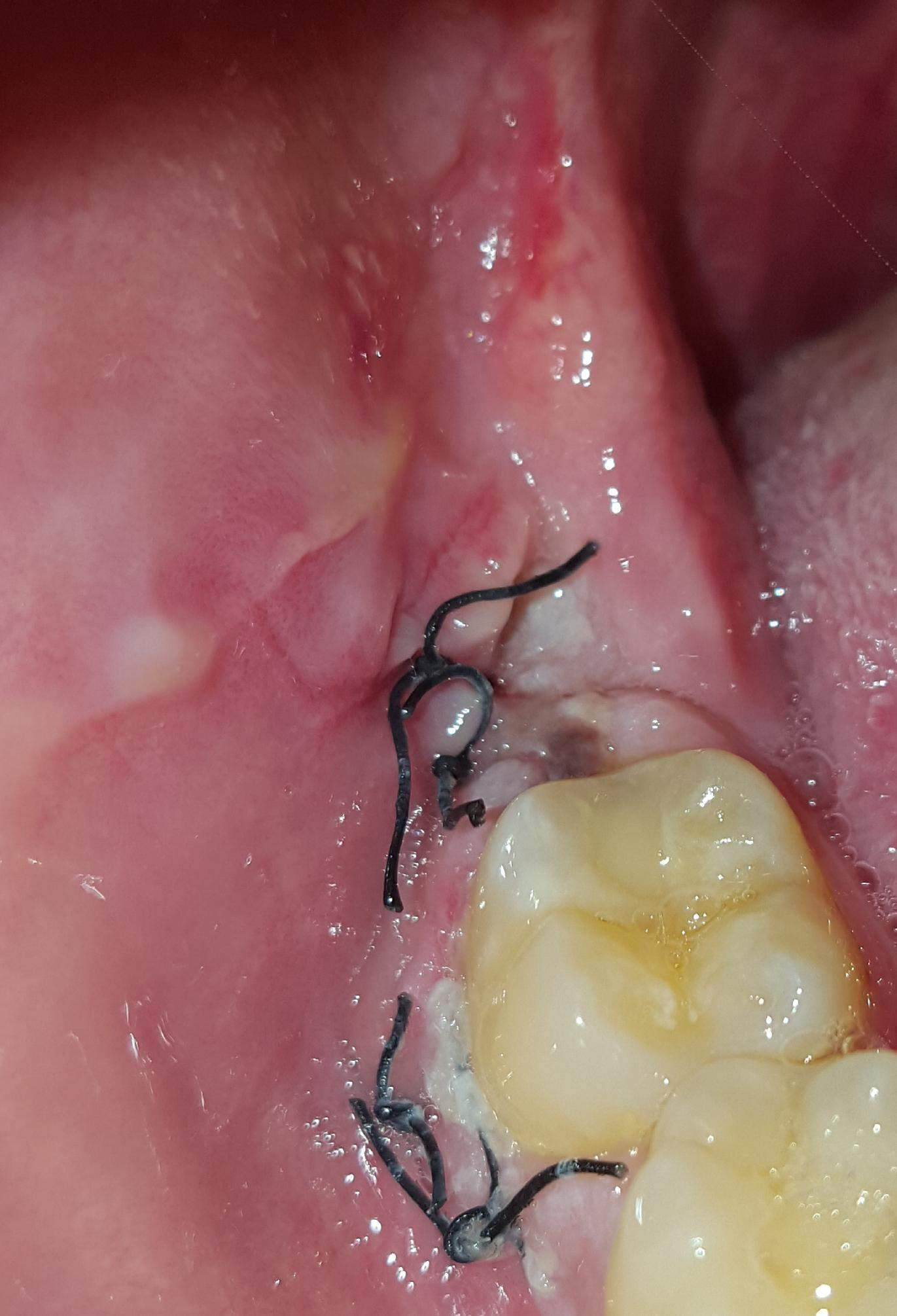 Sieht die Wunde in Ordnung aus? (Medizin, Weisheitszahn-OP)
