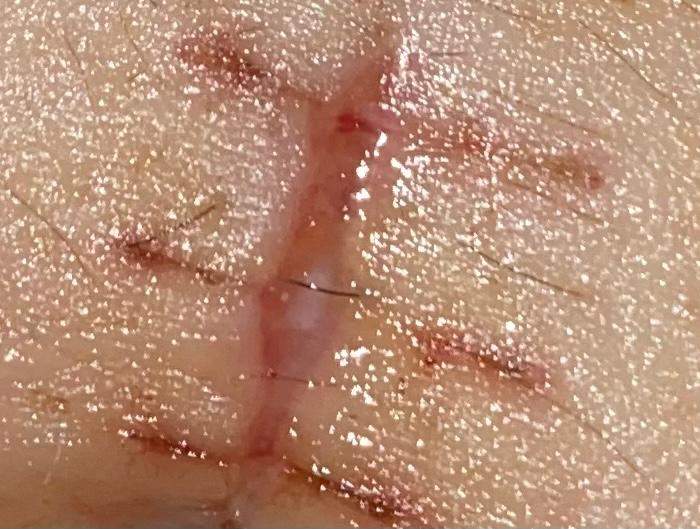 Sieht diese Op Narbe am Bauch normal aus? (Haut, Gesundheit, Operation) Sieht diese Op Narbe am Bauch normal aus? (Haut, Gesundheit, Operation)