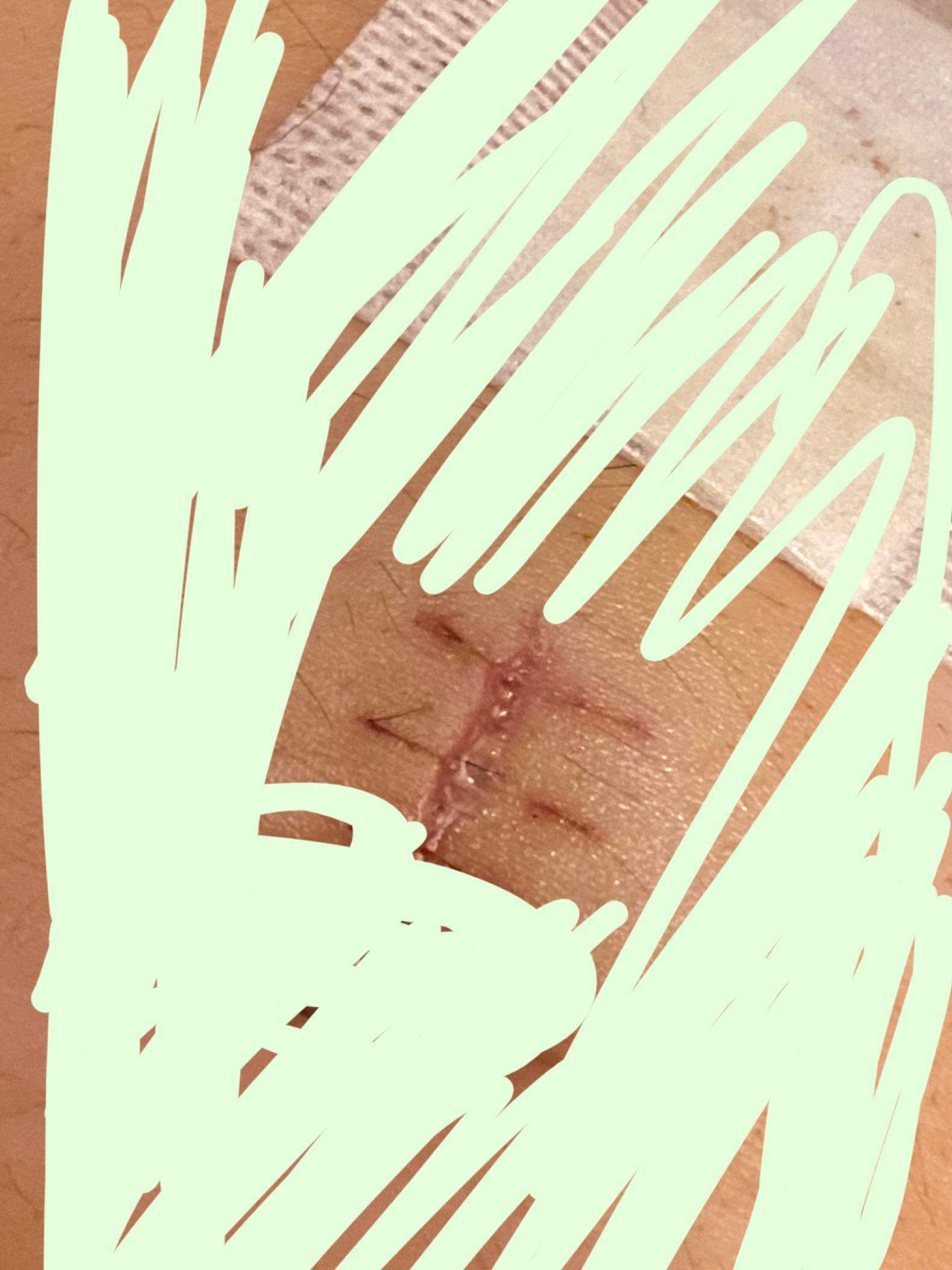Sieht diese Op Narbe am Bauch normal aus? (Haut, Gesundheit, Operation) Sieht diese Op Narbe am Bauch normal aus? (Haut, Gesundheit, Operation)