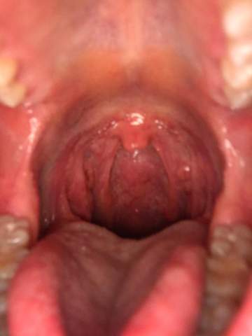 Sieht mein Hals/Rachen gesund aus?