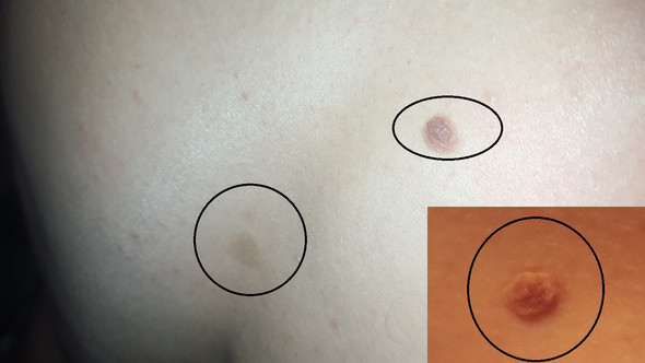 das sind die 3 - (Haut, Arzt, Hautkrebs)