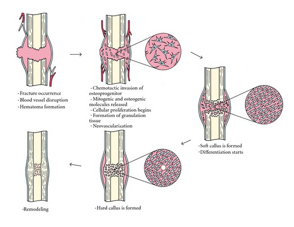 - (Orthopädie, Knochen, osteoporose)