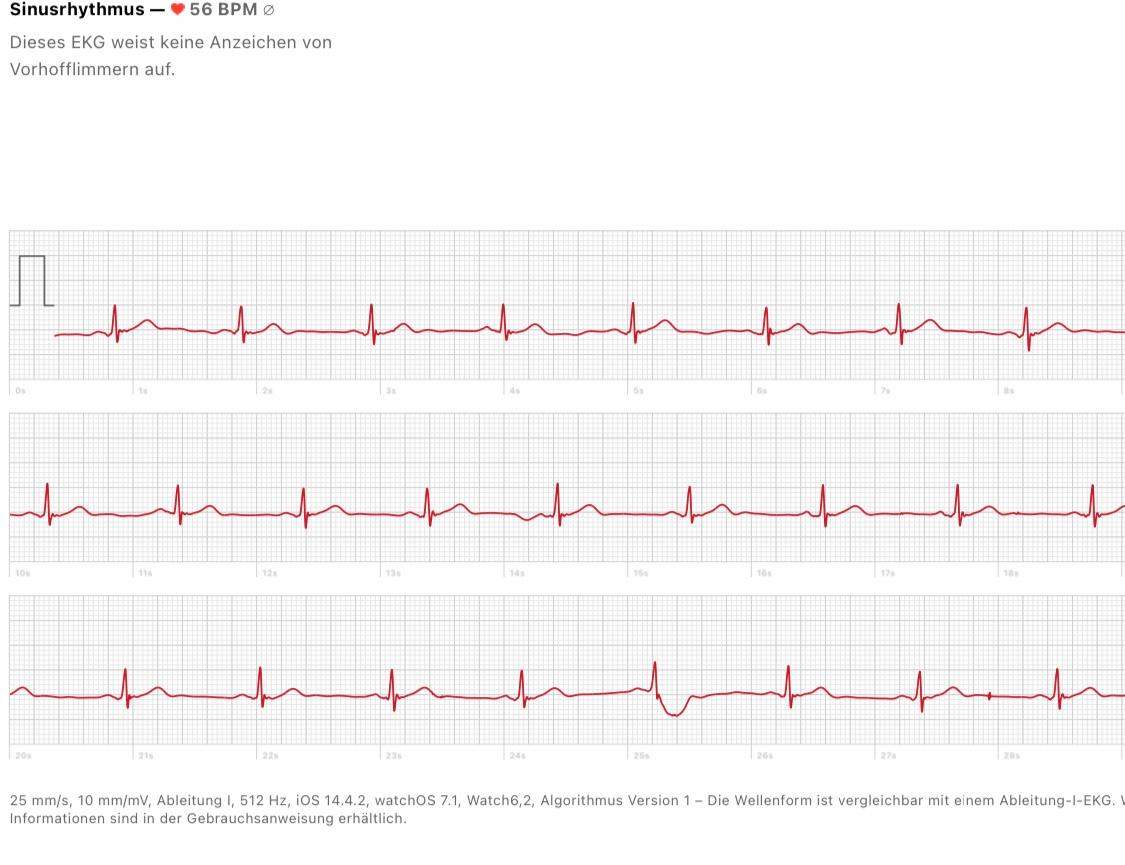 Wie Sieht Ein Auffälliges Ekg Aus www.gesundheitsfrage.net