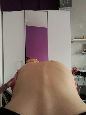 Skoliose Geht Sie Nach Dem Wachstum Weiter Rucken Wirbelsaule