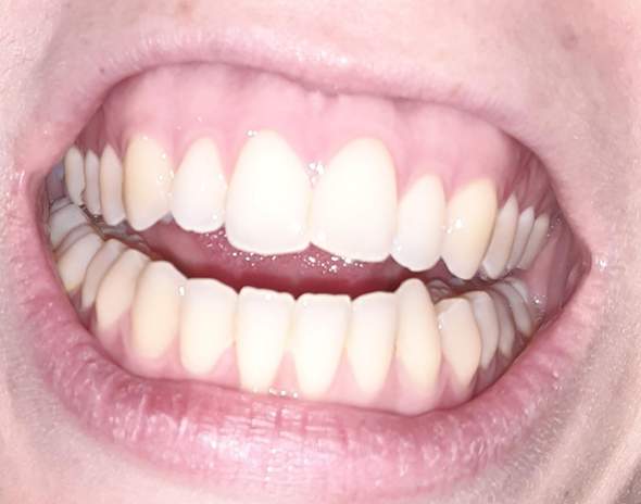 Soll ich meine Zähne durch Aligner richten lassen? Für wie teuer würdet ihr die Behandlung einschätzen?