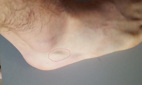 Spitzer Fußknochen? (Füße, Knochen, rechts)