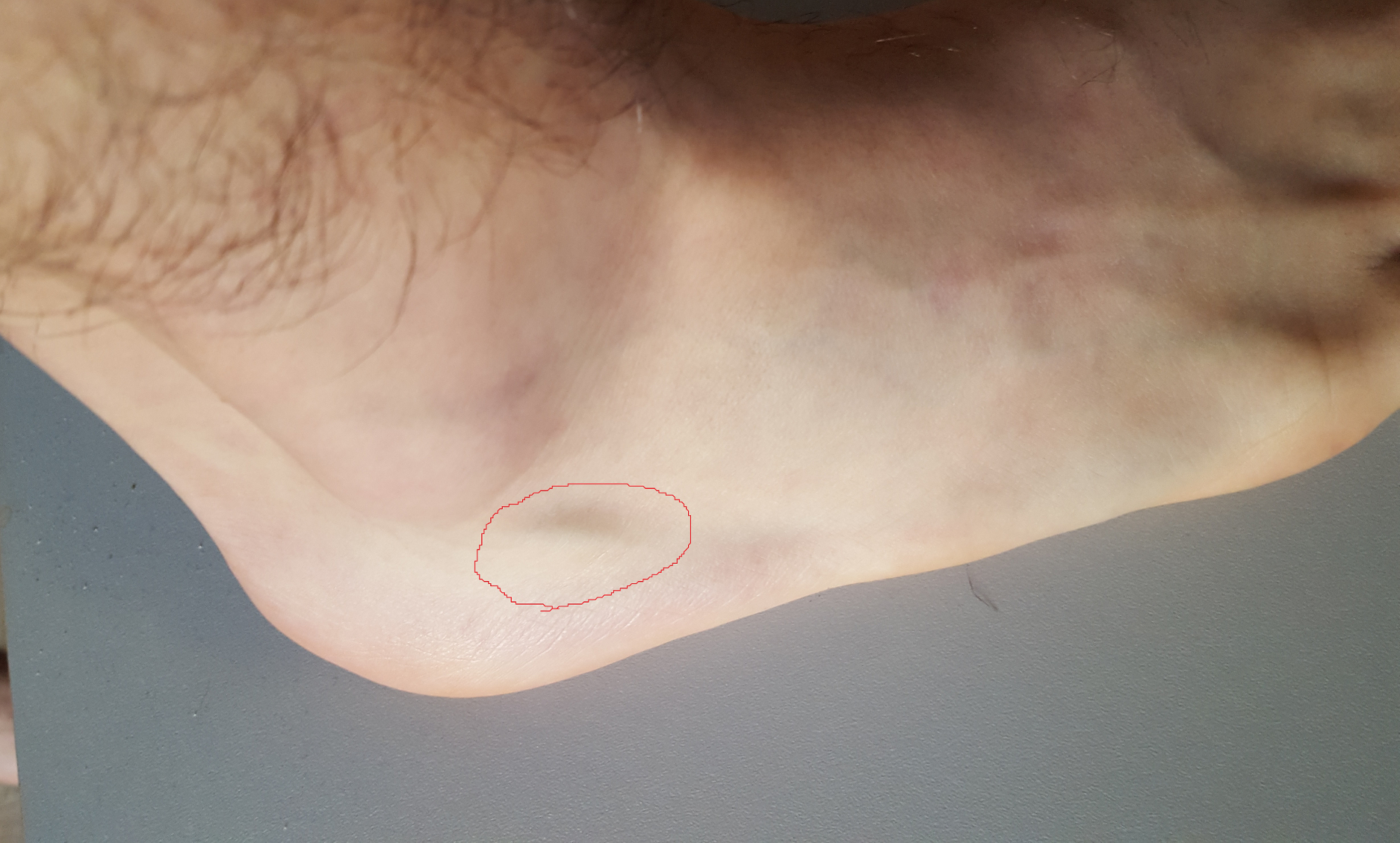 Spitzer Fußknochen? (Füße, Knochen, rechts) Spitzer Fußknochen? (Füße, Knochen, rechts)