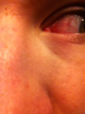 Sporadisch Schmerzen Im Linken Arm Kribbeln Taubheit Rote Punkte Benommenheit Taubheitsgefuhl Sporadisch Schmerzen Im Linken Arm Kribbeln Taubheit Rote Punkte Benommenheit Taubheitsgefuhl