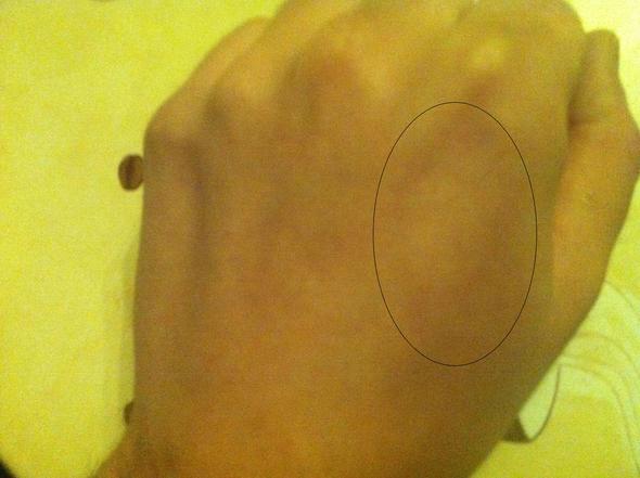 Sporadisch Schmerzen Im Linken Arm Kribbeln Taubheit Rote Punkte Benommenheit Taubheitsgefuhl Sporadisch Schmerzen Im Linken Arm Kribbeln Taubheit Rote Punkte Benommenheit Taubheitsgefuhl