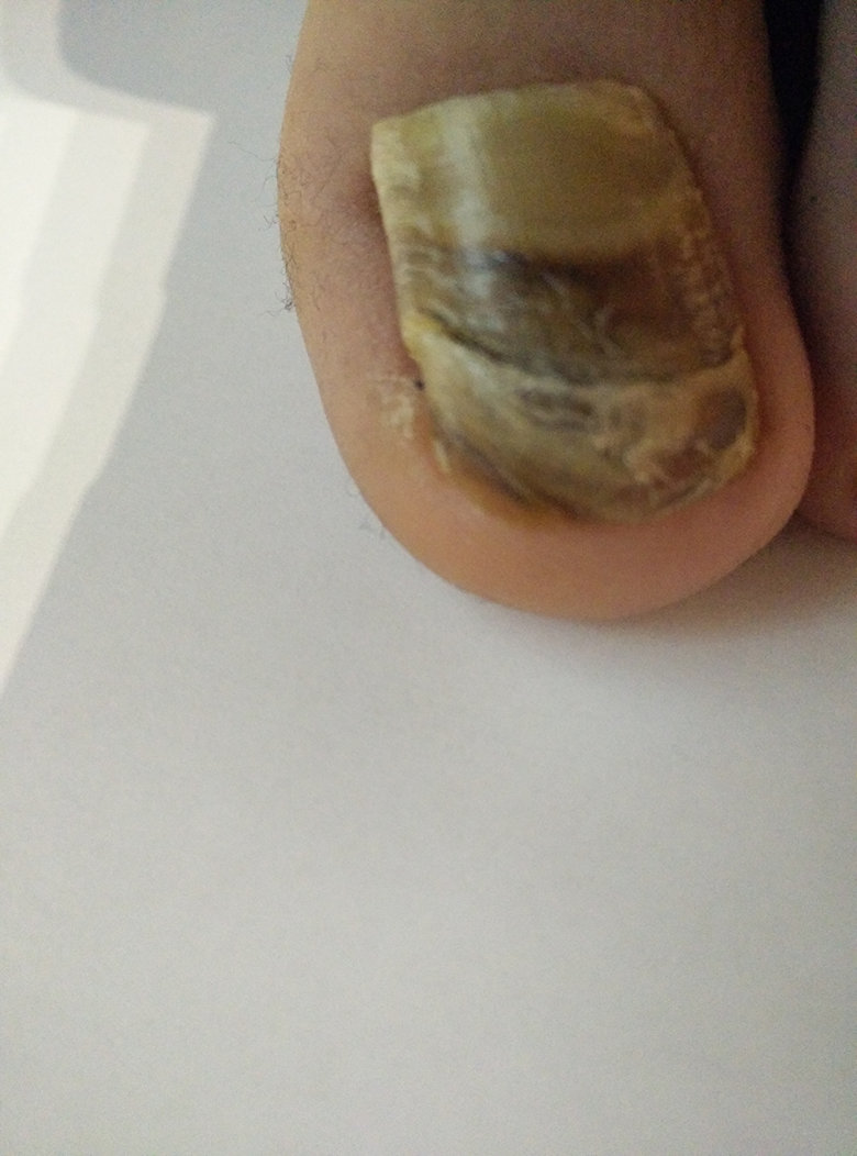 Stark Bunt Verfarbter Und Verdickter Grosser Zehnagel Keine Schmerzen Laut Untersuchung Kein Nagelpilz Was Kann Das Denn Sein Mit Bildern Zeh Fussnagel Stark Bunt Verfarbter Und Verdickter Grosser Zehnagel Keine Schmerzen Laut Untersuchung Kein Nagelpilz Was Kann Das Denn Sein Mit Bildern Zeh Fussnagel