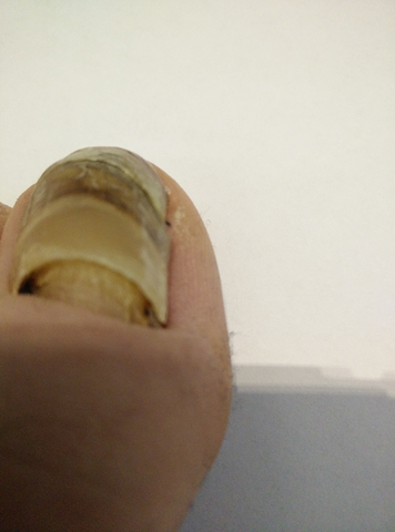 Stark Bunt Verfarbter Und Verdickter Grosser Zehnagel Keine Schmerzen Laut Untersuchung Kein Nagelpilz Was Kann Das Denn Sein Mit Bildern Zeh Fussnagel Stark Bunt Verfarbter Und Verdickter Grosser Zehnagel Keine Schmerzen Laut Untersuchung Kein Nagelpilz Was Kann Das Denn Sein Mit Bildern Zeh Fussnagel