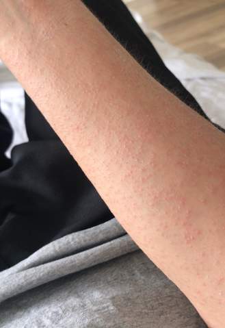 Pusteln krätze behandlung neue nach Scabies/Krätze, trotz