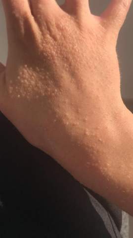 Starker Juckreiz Und Ausschlag Nach Kratzebehandlung Antiscabiosum 25 Haut Allergie Dermatologie Starker Juckreiz Und Ausschlag Nach Kratzebehandlung Antiscabiosum 25 Haut Allergie Dermatologie