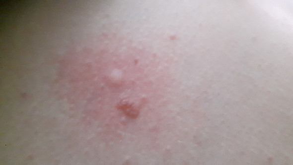 - (Allergie, stechen, Roter stich)