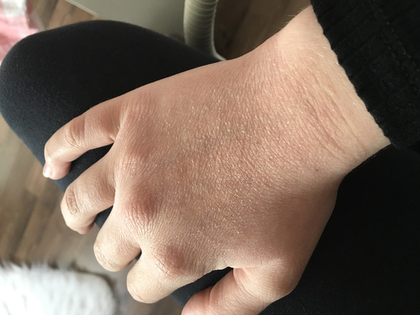 Ist das erste mal jetzt aufgetreten  - (Haut, Hand, Dermatologie)