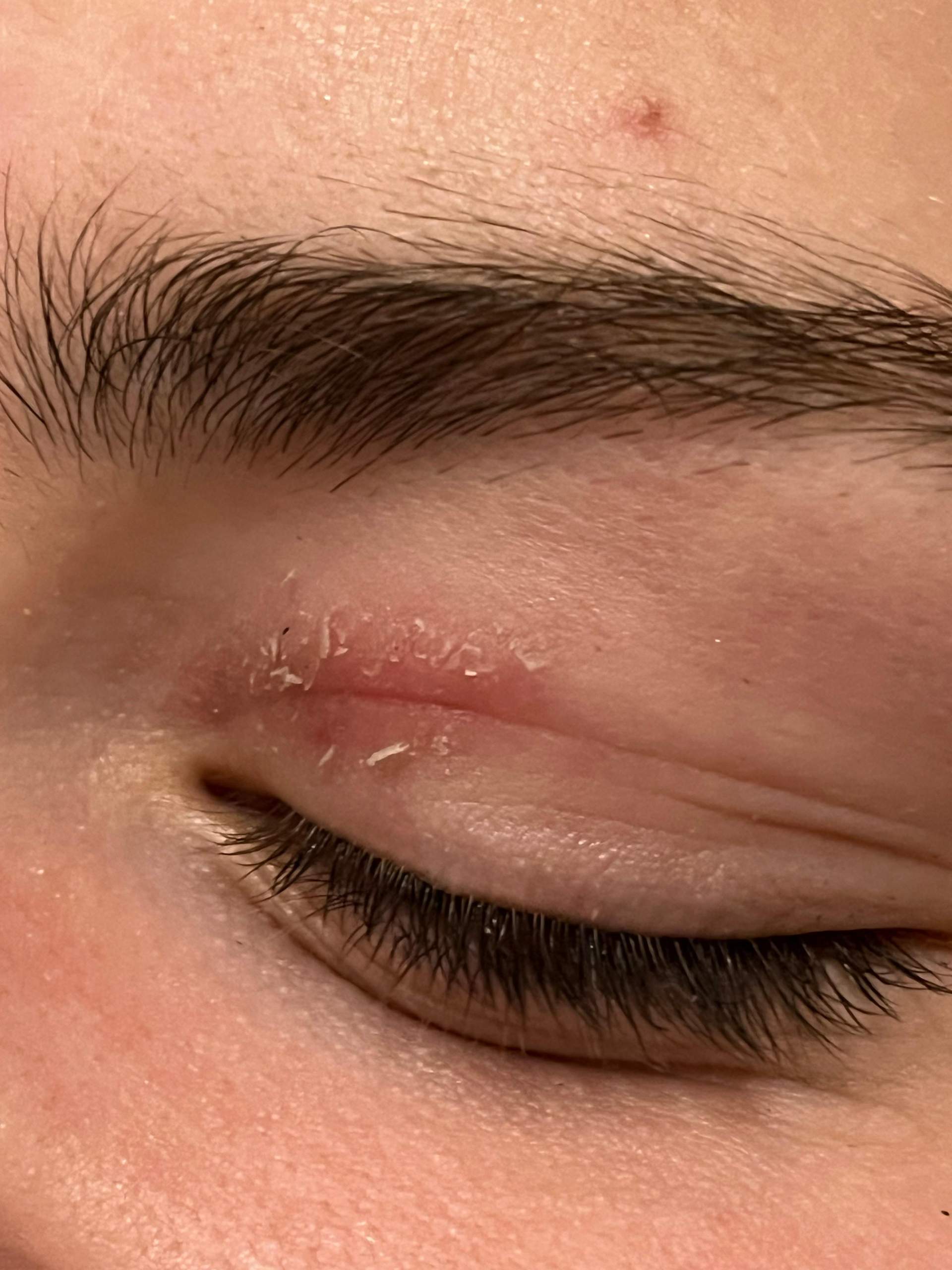 Trockenes Augenlid? (Haut, Augen, trockene Haut)
