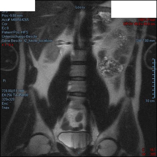 Tumor Auf MRT Aufnahmen tumor-auf-mrt-aufnahmen