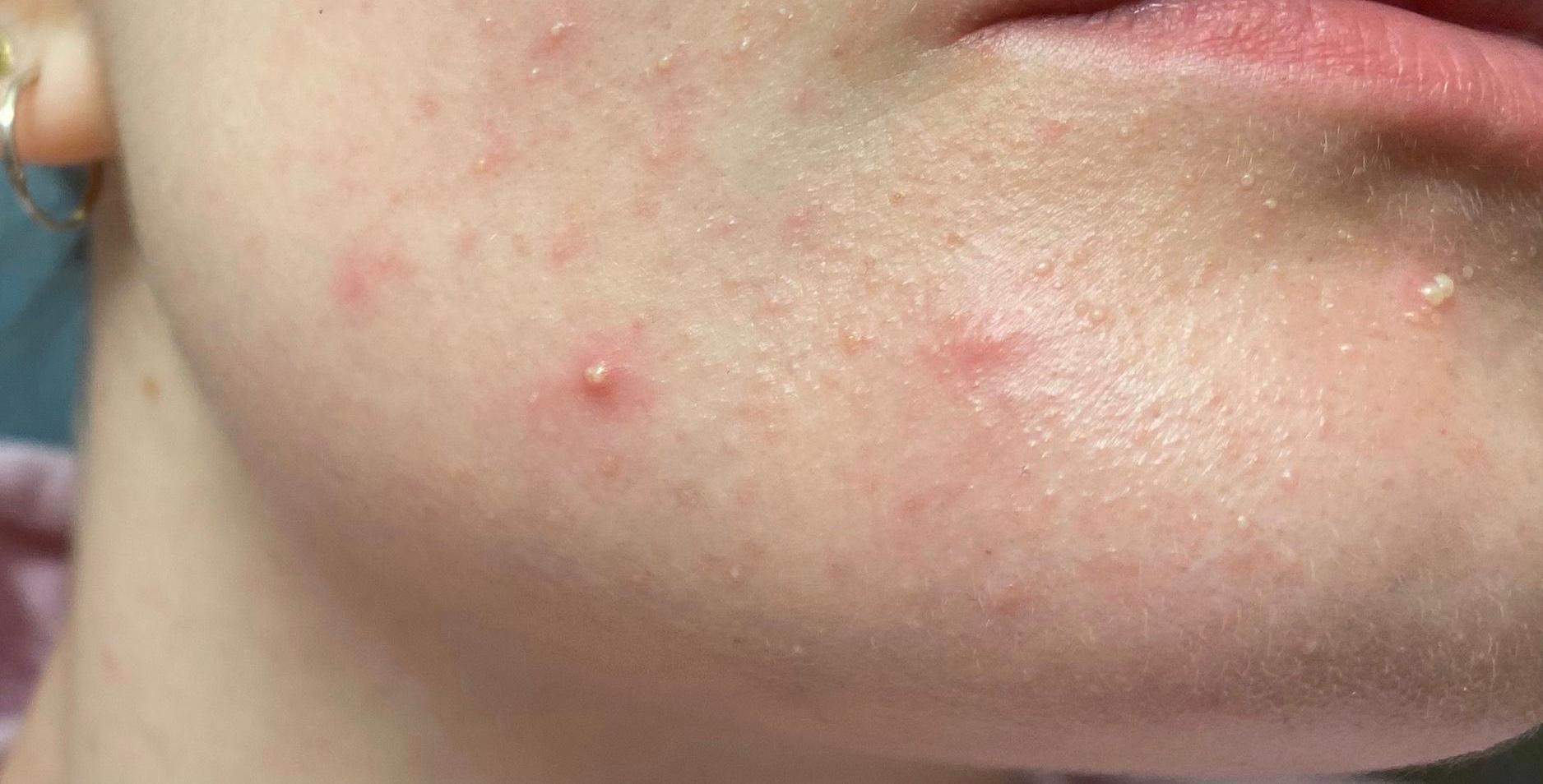 Ã?ber Nacht plötzlich viele kleine Pickel? (Haut) pickel loswerden über nacht