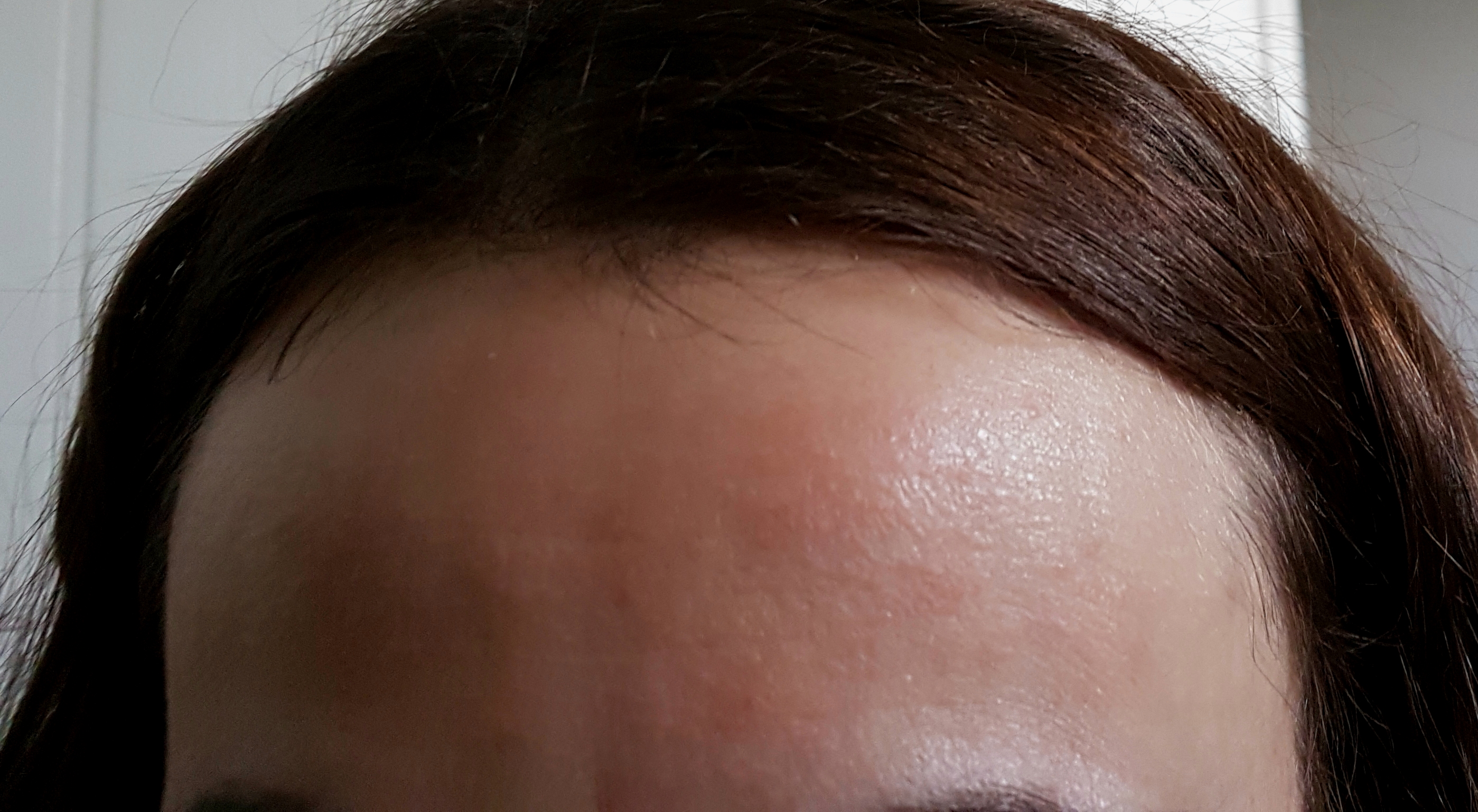 Um was könnte es sich auf der Stirn handeln? (Dermatologie)