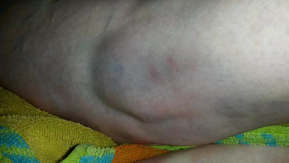 Unteres Schienbein Gestossen Fusse Schwellung Blauer Fleck Unteres Schienbein Gestossen Fusse Schwellung Blauer Fleck