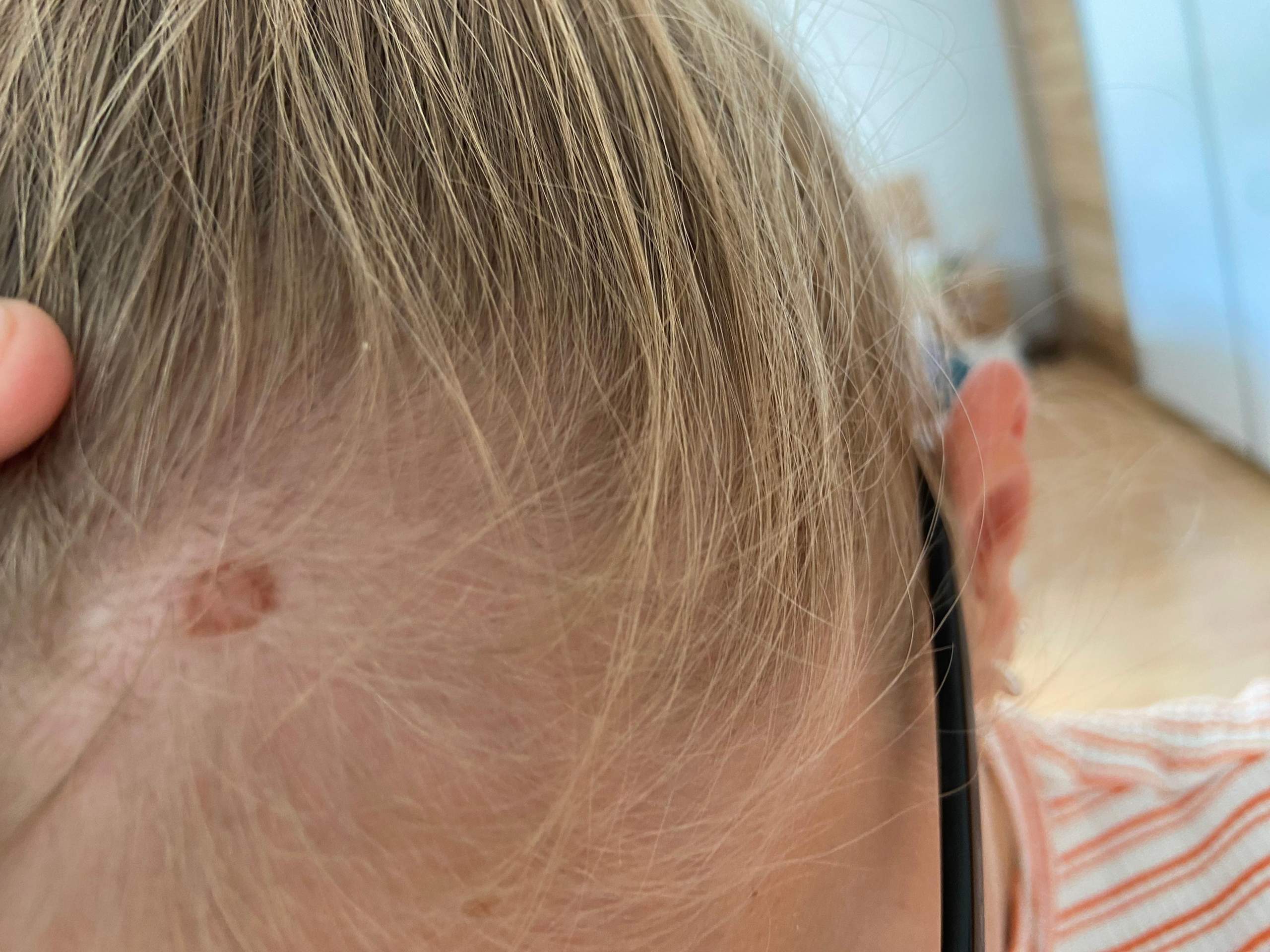 Veränderung auf der Kopfhaut? (hautarzt, Hauterkrankung)