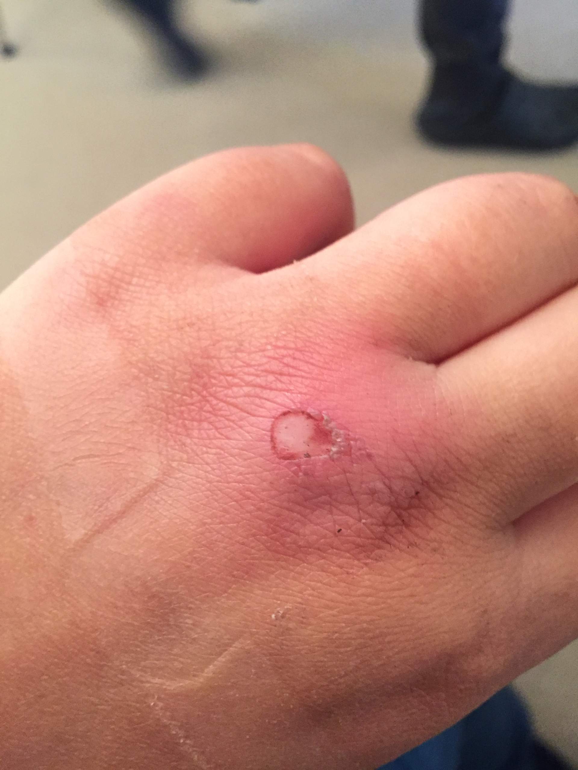 Verbrennung am Fingerknöchel. Entzündung? (Finger)