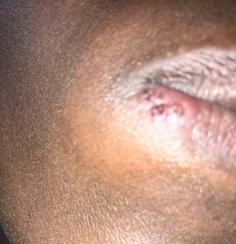 Verkrustung auf der Lippe - ist das Herpes?