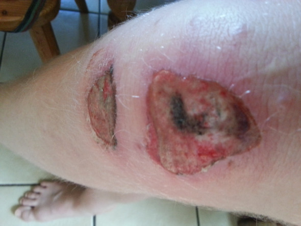Nach dem Unfall - (Haut, Knie, Blut)