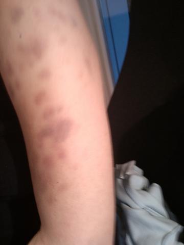 Viele Blaue Flecken Am Arm Ohne Grund Durch Kratzen Hilfe Haut Juckreiz Hamatom Viele Blaue Flecken Am Arm Ohne Grund Durch Kratzen Hilfe Haut Juckreiz Hamatom