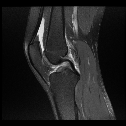 Impressionsfraktur Knie