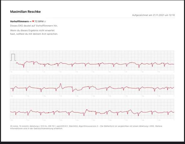 Vorhofflimmern Apple Watch EKG? (Herz)