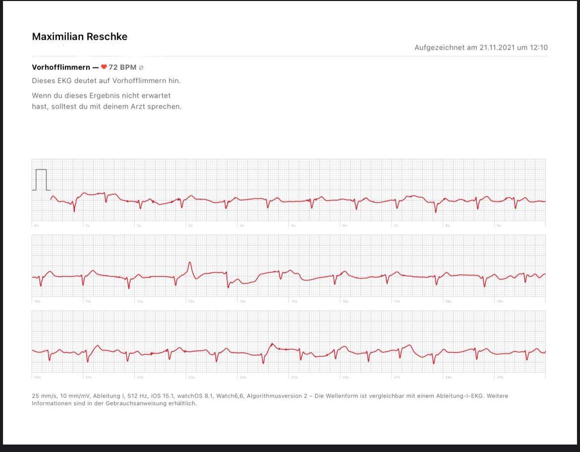 Vorhofflimmern Apple Watch Ekg Beispiele