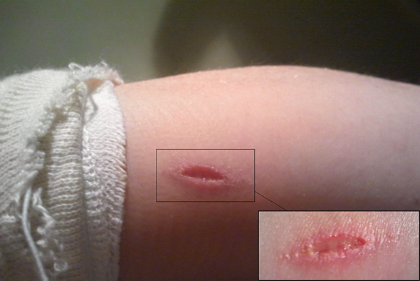 Wachst Das Noch Zusammen Heilung Schnittwunde Svv Wachst Das Noch Zusammen Heilung Schnittwunde Svv