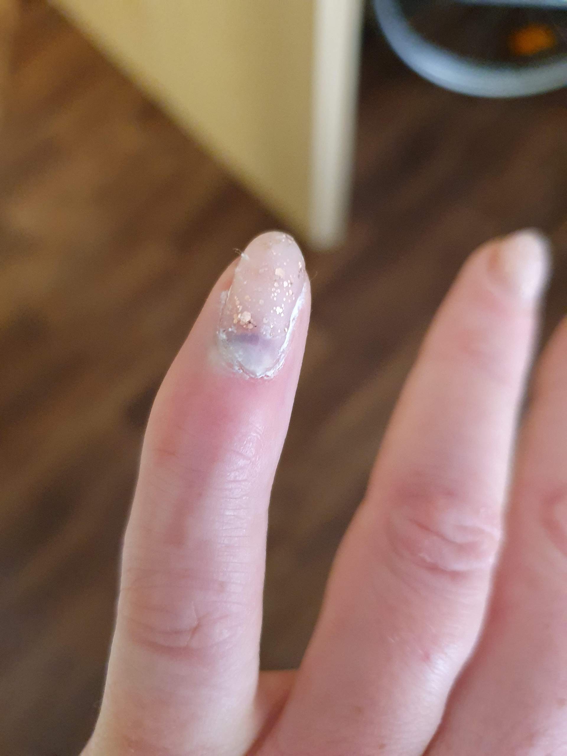 wachst der nagel raus oder muss ich damit zum arzt finger fingernagel