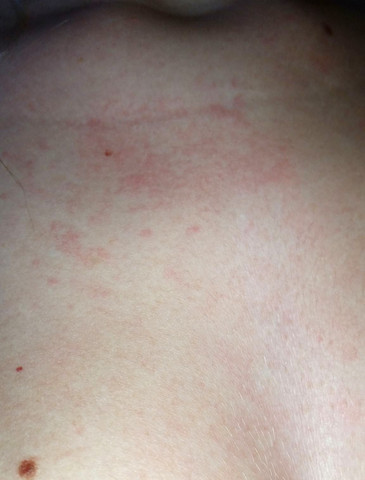 Ausschlag hiv Akute HIV