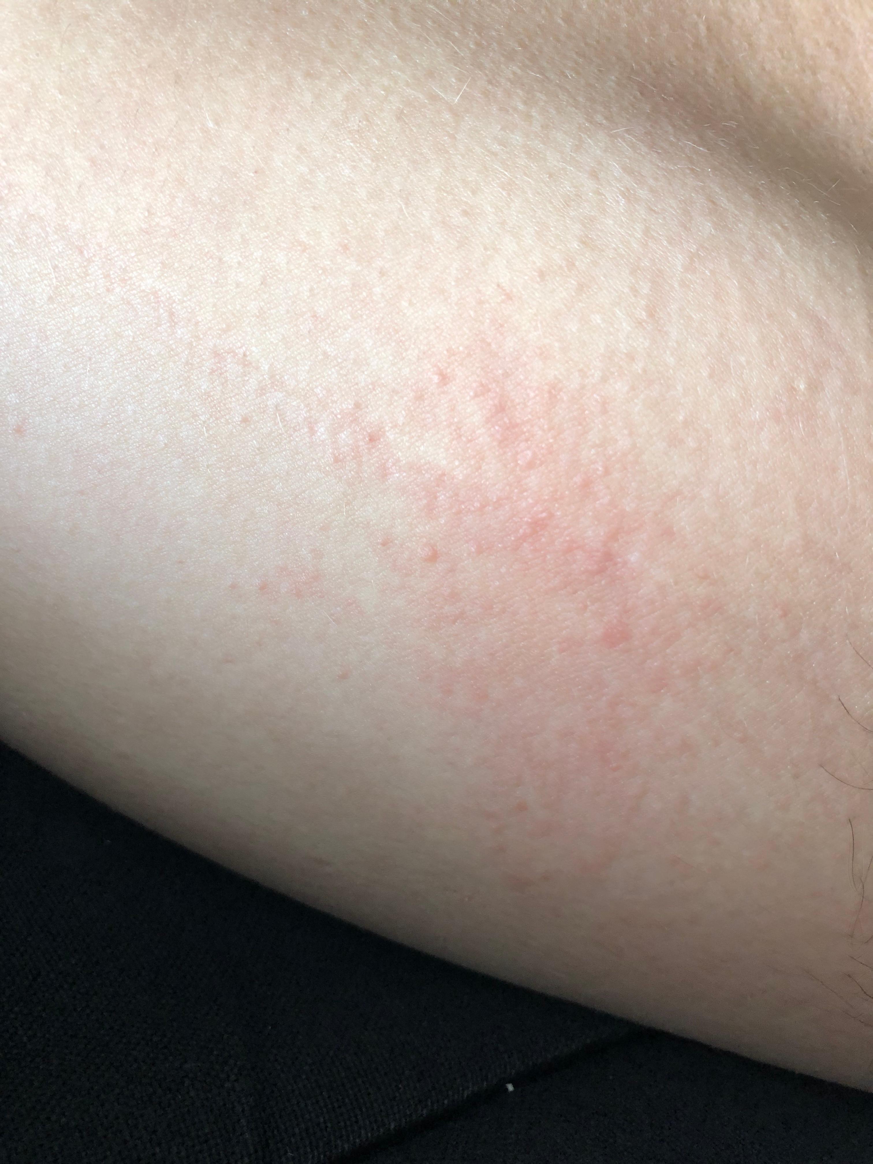 Wandernder und juckender ausschlag? (juckreiz, dermatologie, neurodermitis) Wandernder und juckender Ausschlag? (Juckreiz, Dermatologie, Neurodermitis)