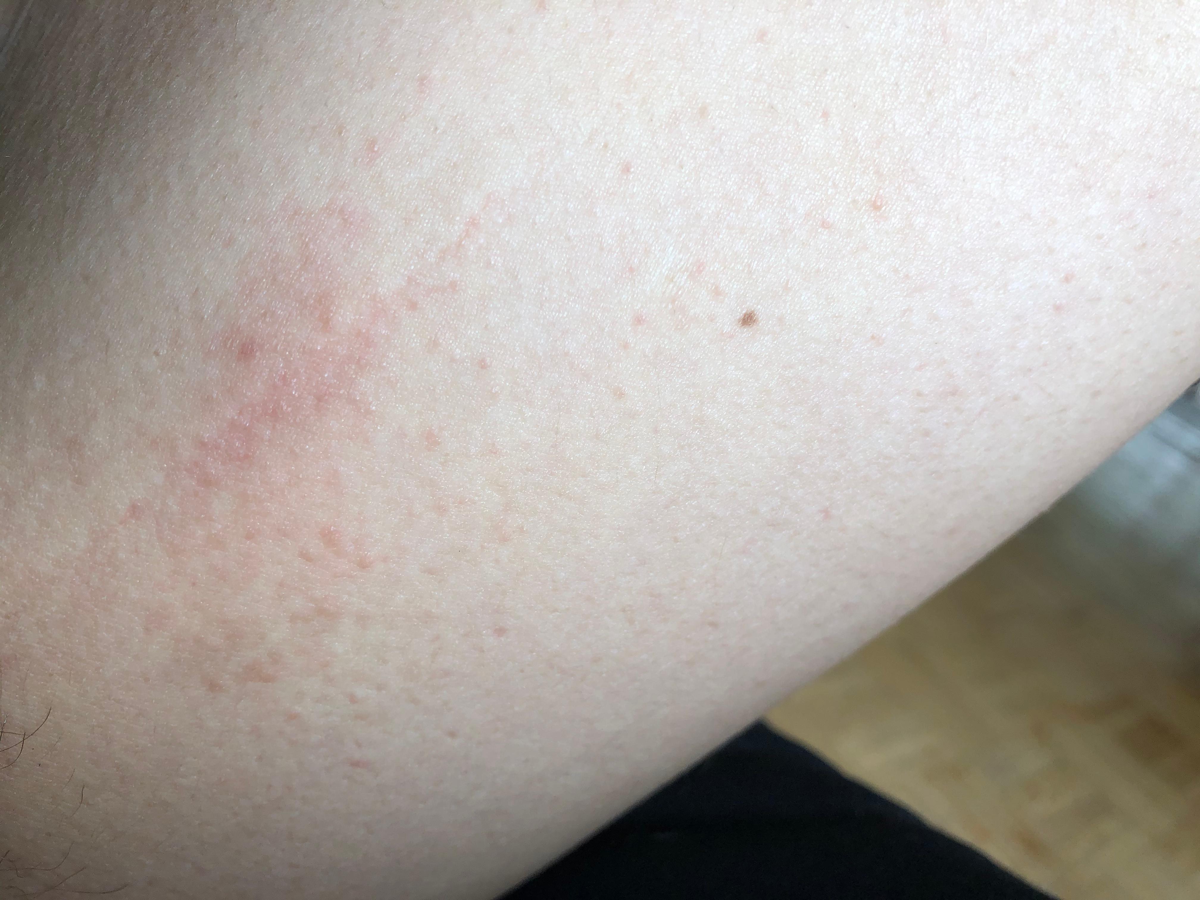 Wandernder und juckender Ausschlag? (Juckreiz, Dermatologie, Neurodermitis)