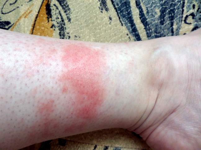 Warme rote Flecken (Beine) Warme rote Flecken (Beine)